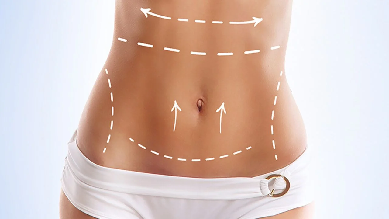 Tummy Tuck